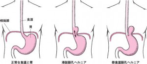 裂孔ヘルニア