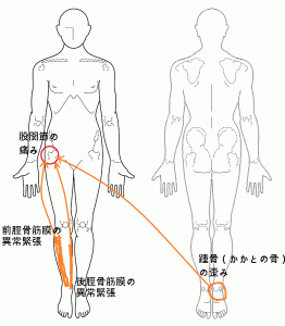 股関節の痛みの原因とその原因解説の図
