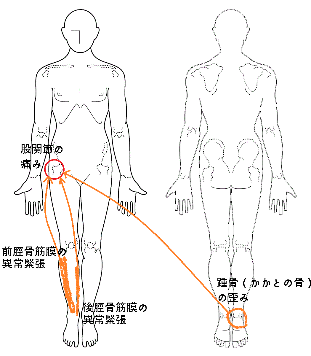 股関節 右だけ痛い 急に